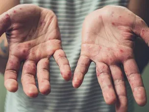 Профилактика кори