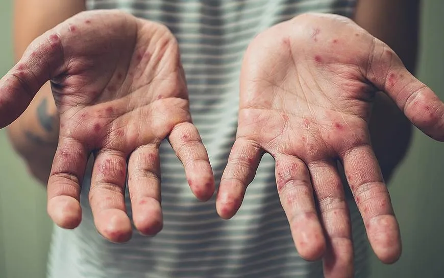 Профилактика кори